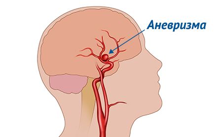 схематическое изображение аневрезмы сосудов головного мозга